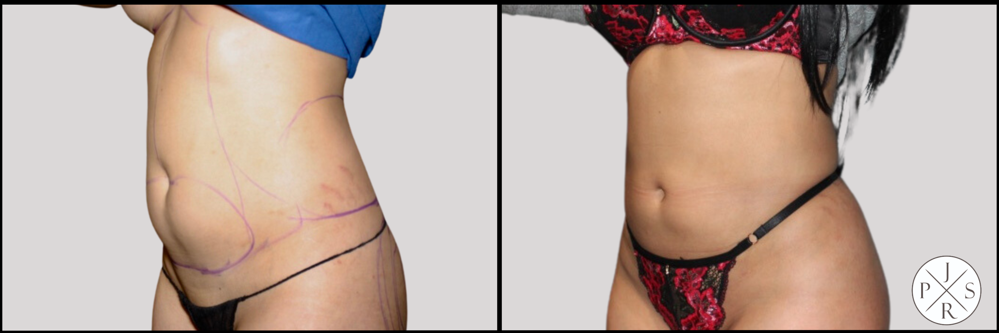 Liposuction Before & After Image